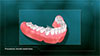 Removable Dentures