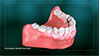 Removable Partial Dentures