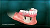 screw retained dentures